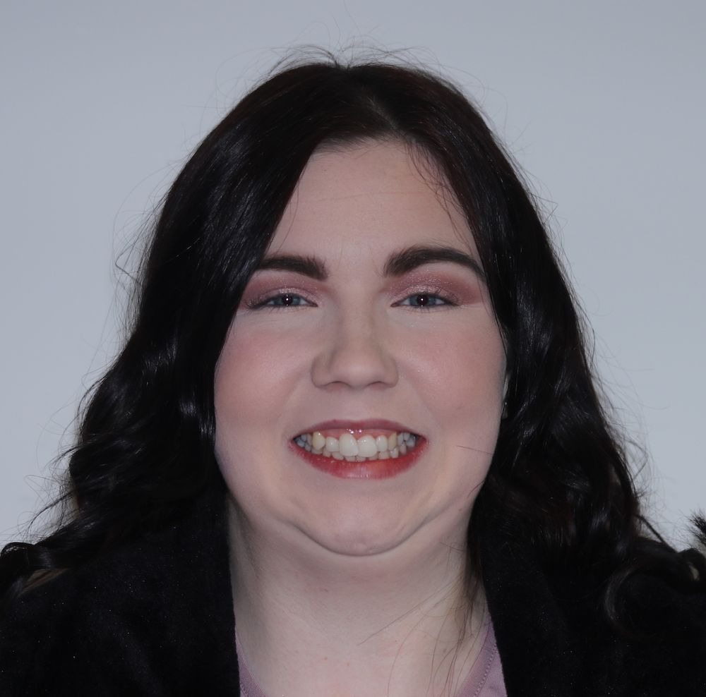 shauna-kerrigan-before-invisalign